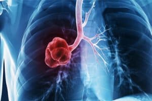 Lung nodules and cancer screening
